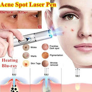 Acne Wrinkle Removal Laser Pen